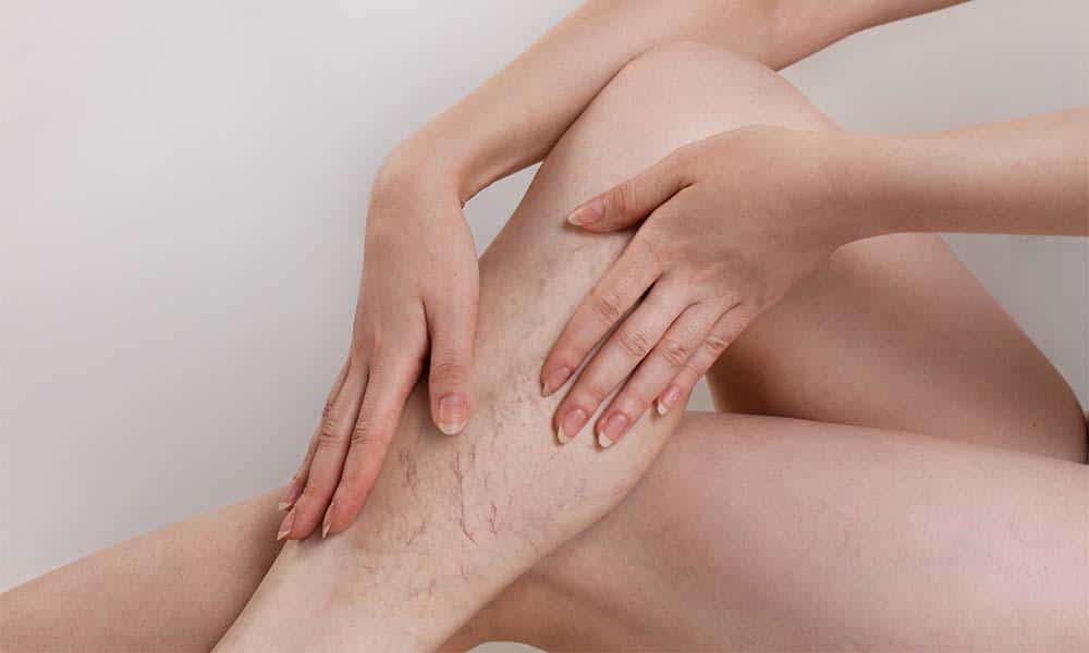 Reduce your risk of varicose veins
